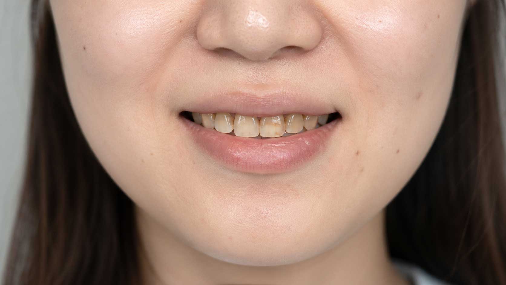 ホワイトニング前の歯