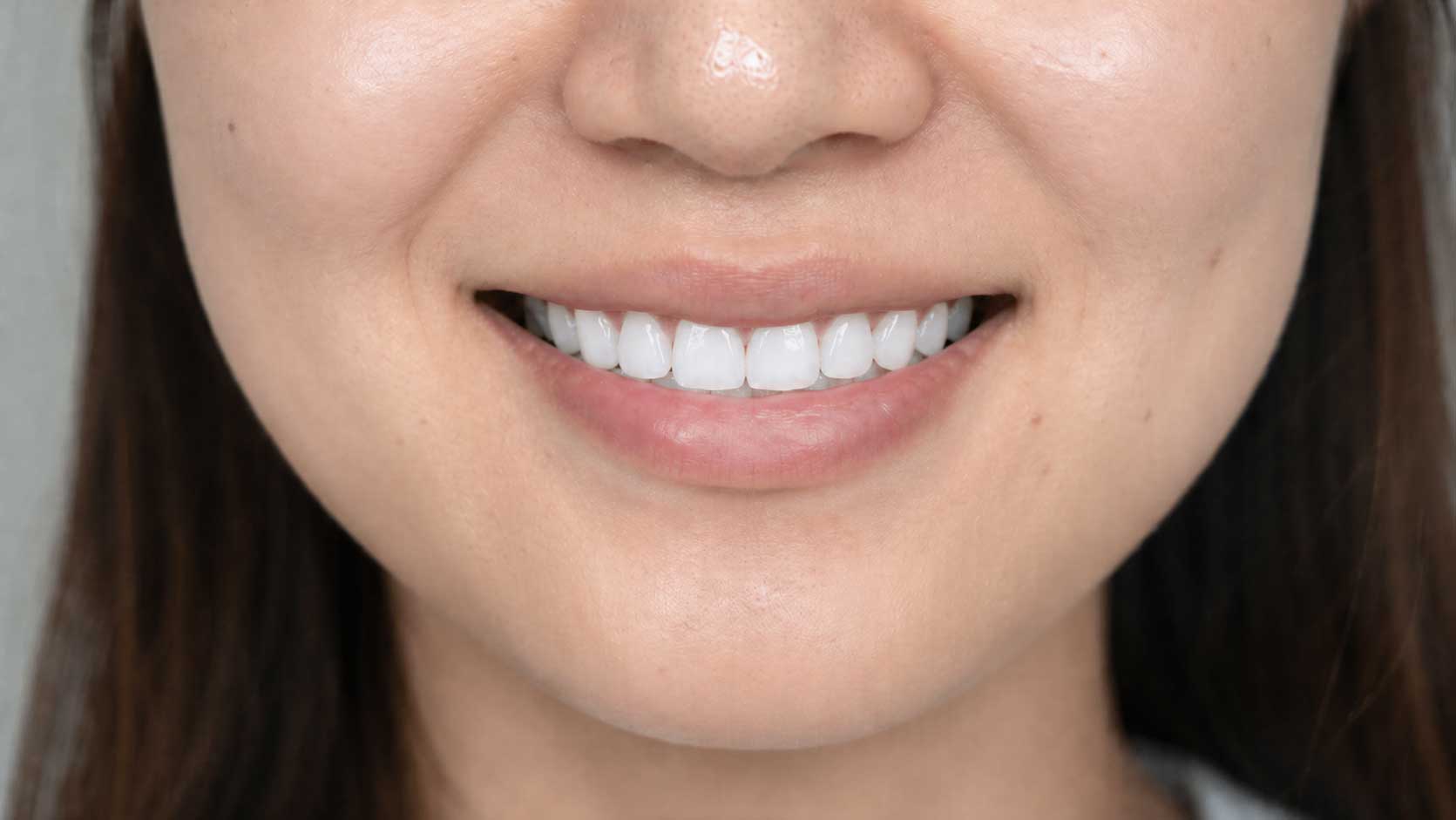 ホワイトニング後の歯