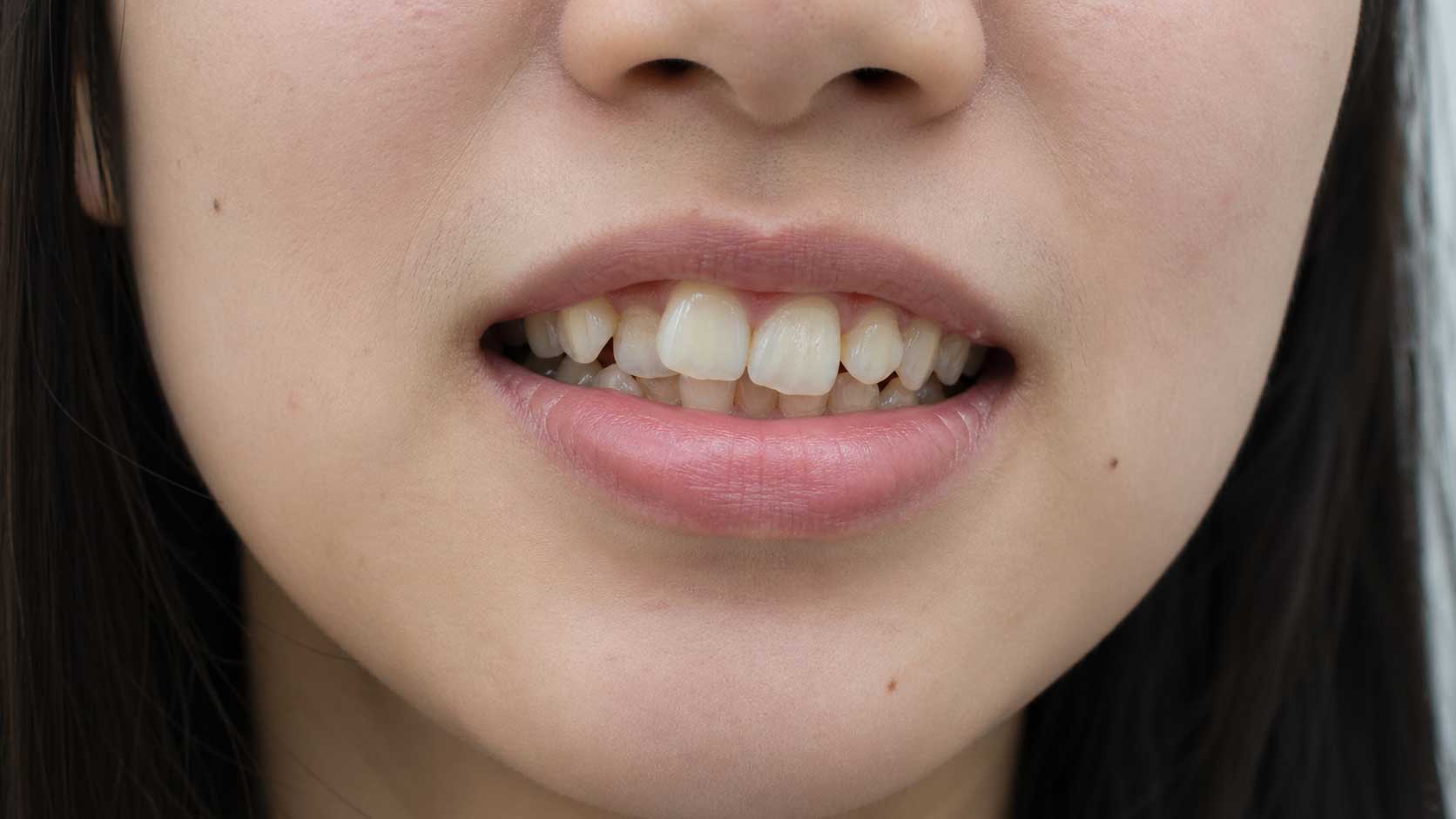 矯正前の歯並び